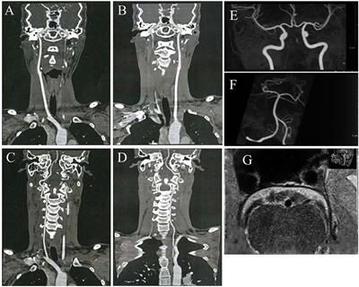 A Cryptogenic Stroke Associated With Infective Endocarditis and Antiphospholipid Antibody Syndrome: Case Report and Literature Review